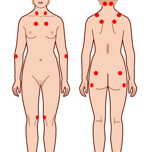 Fibromyalgi
